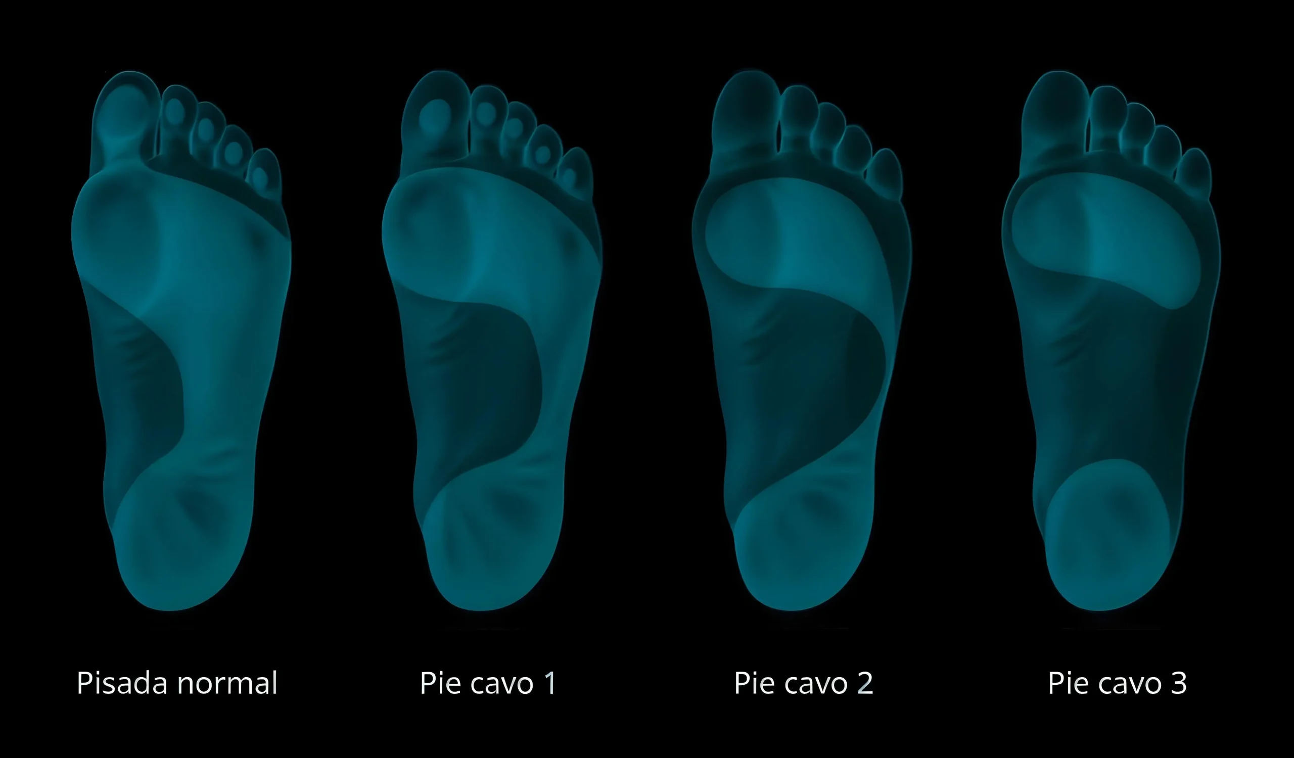 Pisada del pie cavo